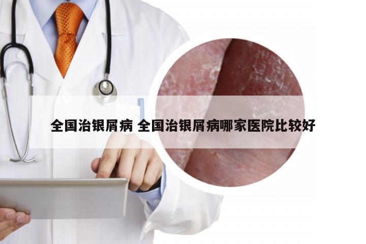 全国治银屑病 全国治银屑病哪家医院比较好