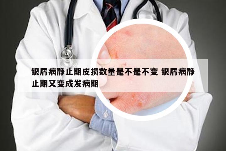 银屑病静止期皮损数量是不是不变 银屑病静止期又变成发病期