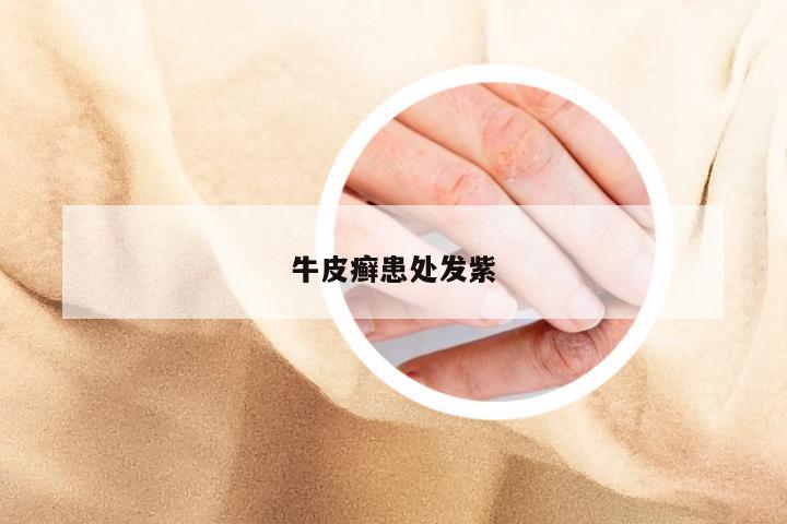 牛皮癣患处发紫