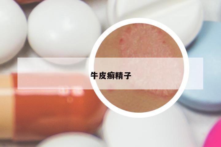 牛皮癣精子