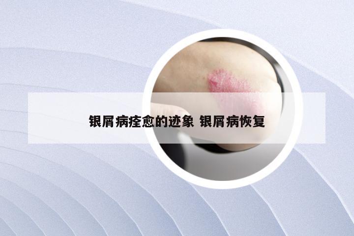 银屑病痊愈的迹象 银屑病恢复