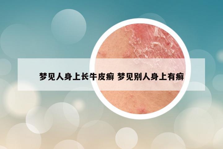 梦见人身上长牛皮癣 梦见别人身上有癣