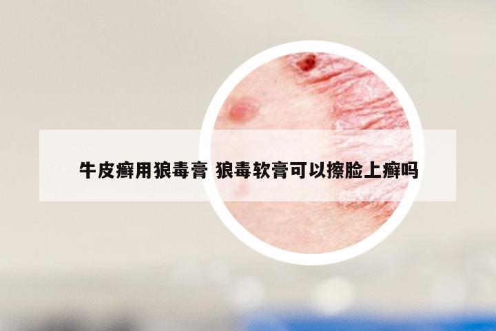 牛皮癣用狼毒膏 狼毒软膏可以擦脸上癣吗