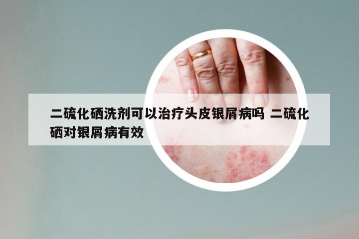 二硫化硒洗剂可以治疗头皮银屑病吗 二硫化硒对银屑病有效