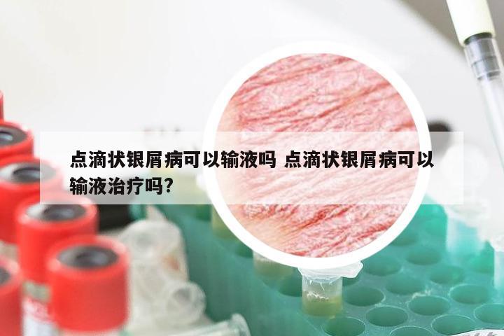点滴状银屑病可以输液吗 点滴状银屑病可以输液治疗吗?