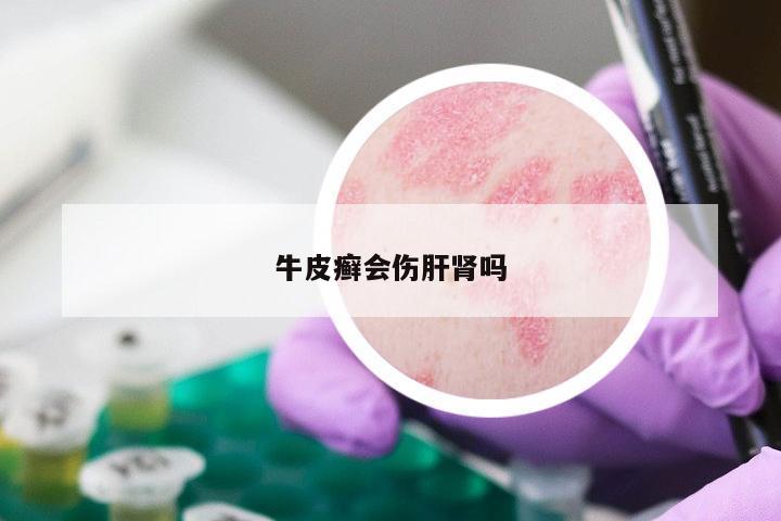 牛皮癣会伤肝肾吗