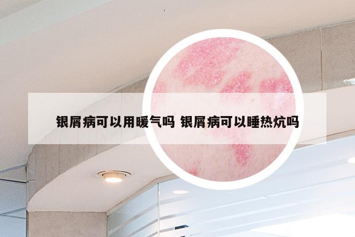 银屑病可以用暖气吗 银屑病可以睡热炕吗