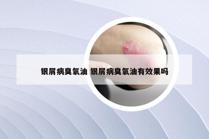 银屑病臭氧油 银屑病臭氧油有效果吗