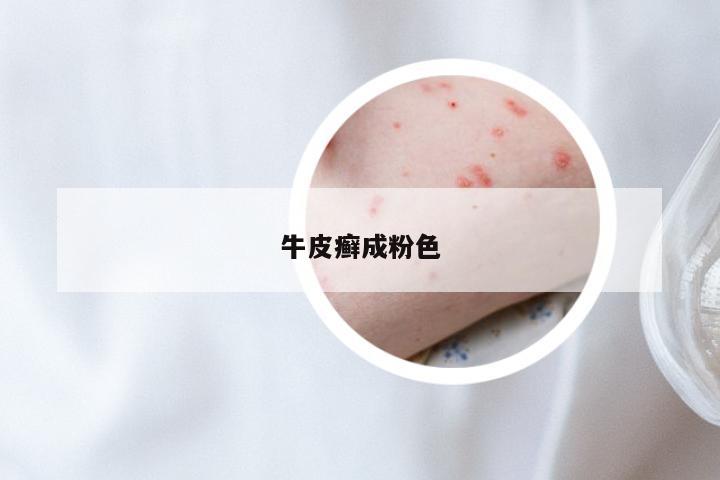 牛皮癣成粉色