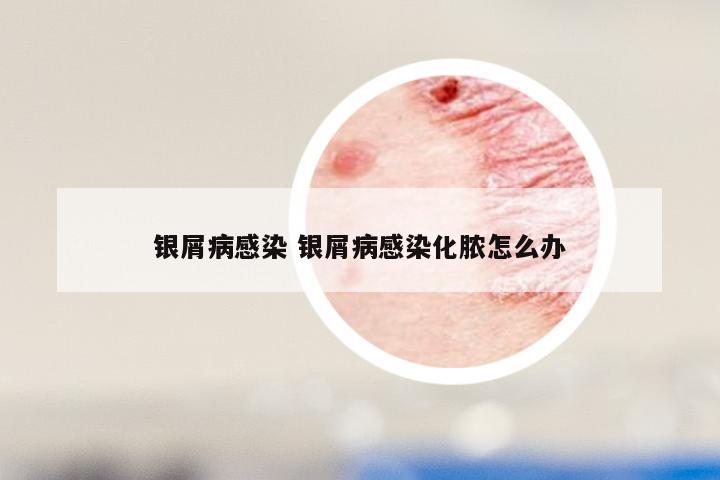 银屑病感染 银屑病感染化脓怎么办