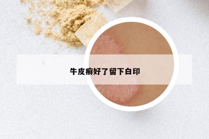 牛皮癣好了留下白印