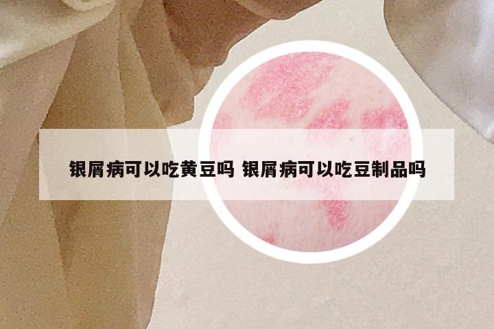 银屑病可以吃黄豆吗 银屑病可以吃豆制品吗