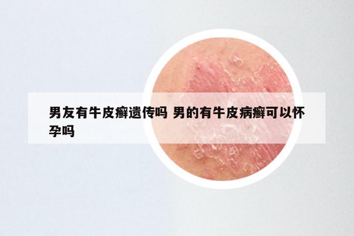男友有牛皮癣遗传吗 男的有牛皮病癣可以怀孕吗