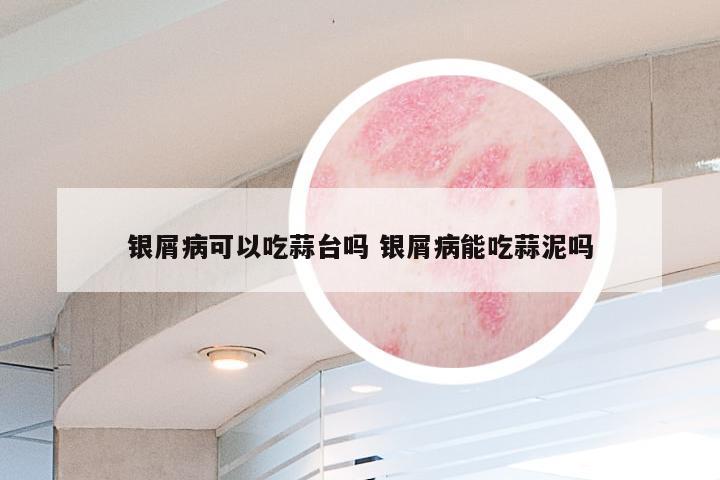 银屑病可以吃蒜台吗 银屑病能吃蒜泥吗