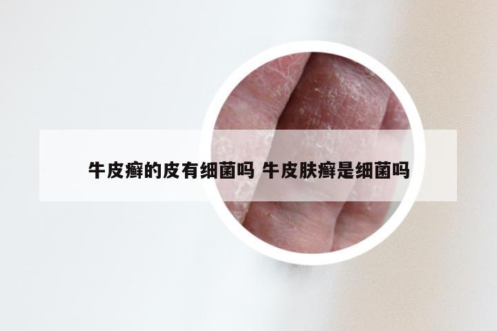 牛皮癣的皮有细菌吗 牛皮肤癣是细菌吗
