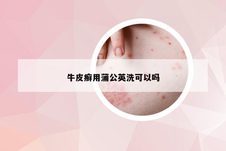 牛皮癣用蒲公英洗可以吗