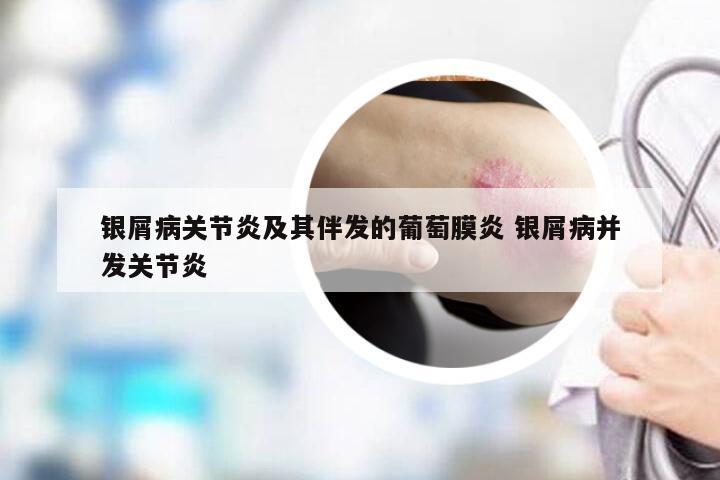 银屑病关节炎及其伴发的葡萄膜炎 银屑病并发关节炎