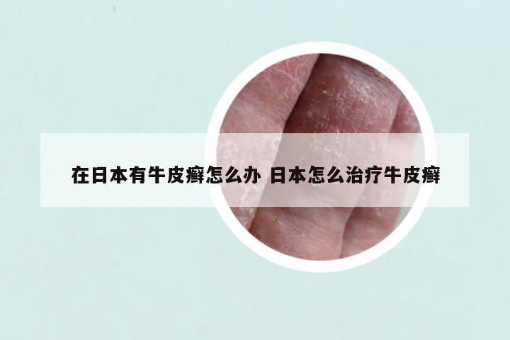 在日本有牛皮癣怎么办 日本怎么治疗牛皮癣