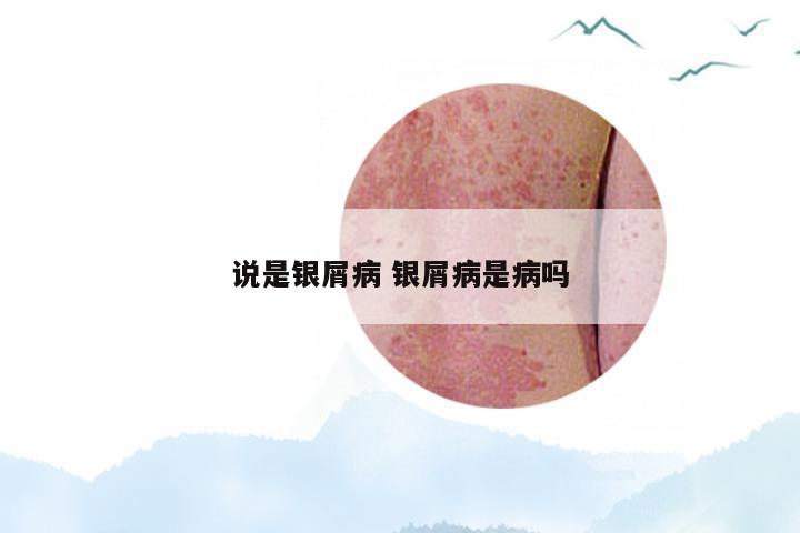 说是银屑病 银屑病是病吗