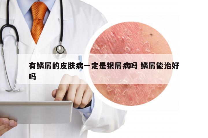 有鳞屑的皮肤病一定是银屑病吗 鳞屑能治好吗