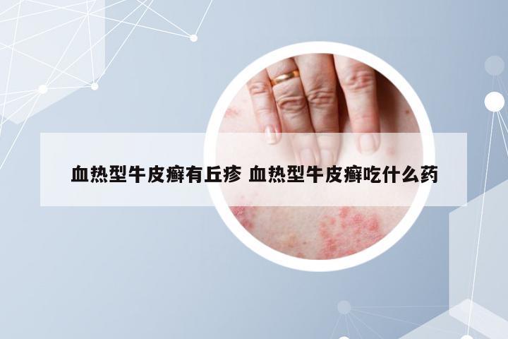 血热型牛皮癣有丘疹 血热型牛皮癣吃什么药