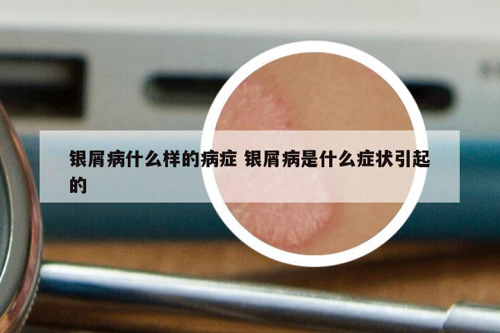 银屑病什么样的病症 银屑病是什么症状引起的