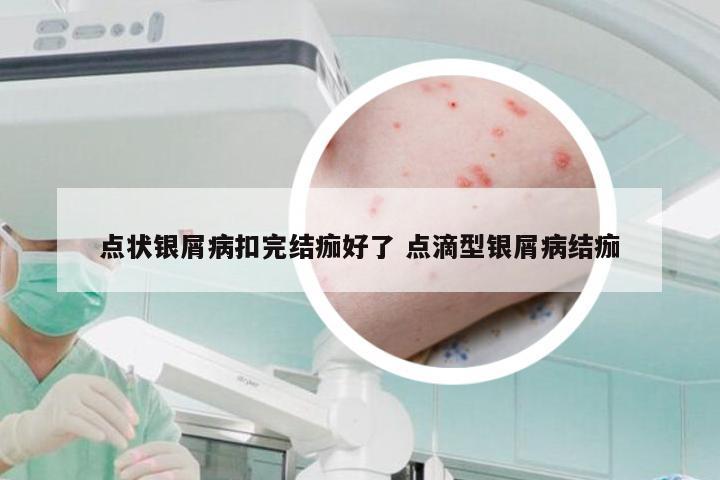 点状银屑病扣完结痂好了 点滴型银屑病结痂