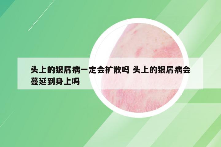 头上的银屑病一定会扩散吗 头上的银屑病会蔓延到身上吗