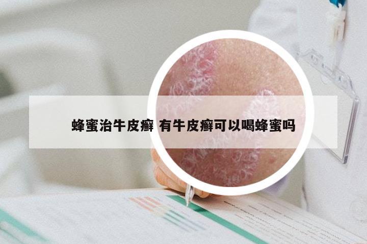 蜂蜜治牛皮癣 有牛皮癣可以喝蜂蜜吗