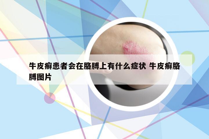 牛皮癣患者会在胳膊上有什么症状 牛皮癣胳膊图片