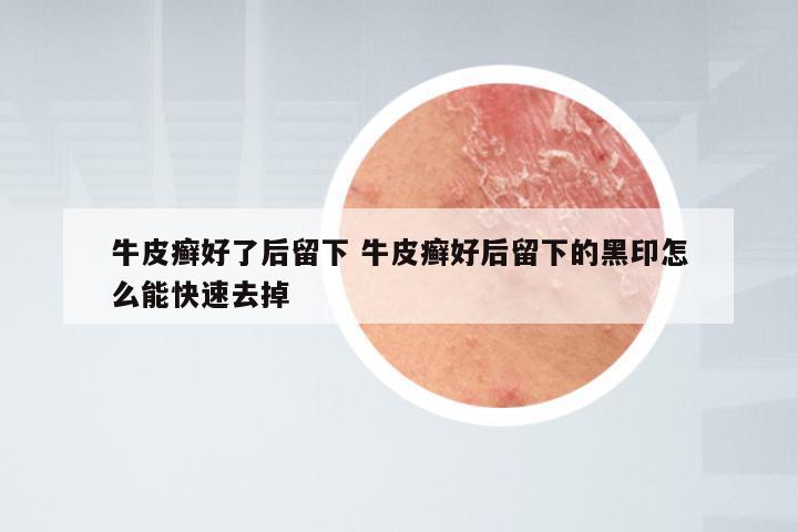 牛皮癣好了后留下 牛皮癣好后留下的黑印怎么能快速去掉