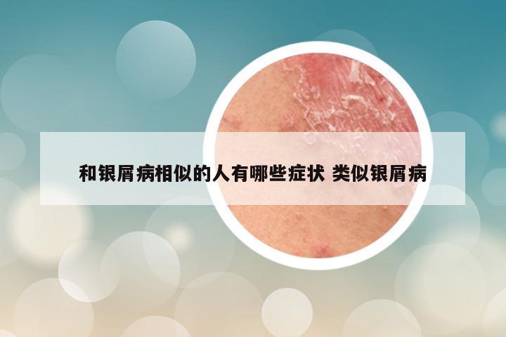 和银屑病相似的人有哪些症状 类似银屑病
