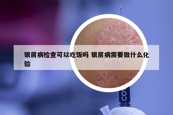 银屑病检查可以吃饭吗 银屑病需要做什么化验