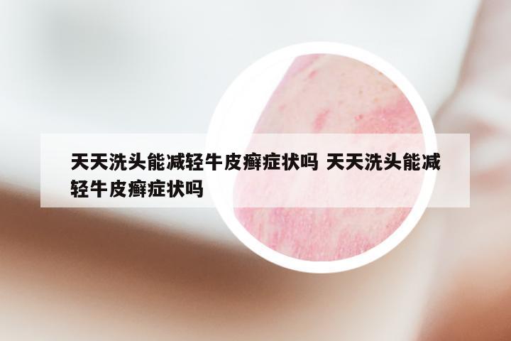 天天洗头能减轻牛皮癣症状吗 天天洗头能减轻牛皮癣症状吗