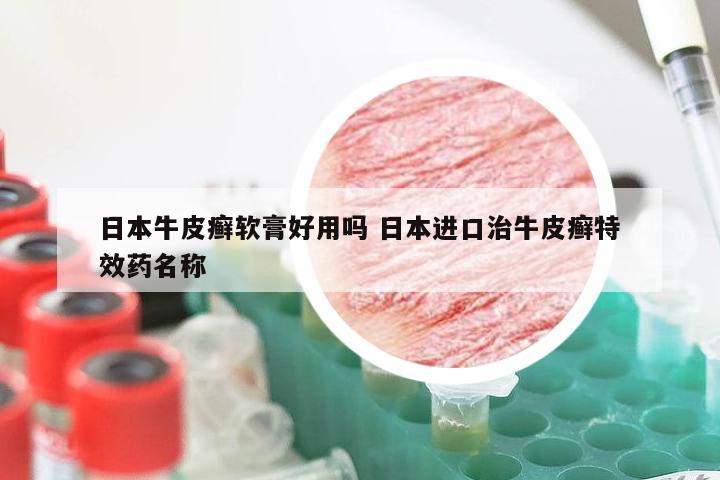 日本牛皮癣软膏好用吗 日本进口治牛皮癣特效药名称