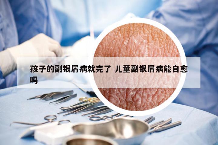 孩子的副银屑病就完了 儿童副银屑病能自愈吗