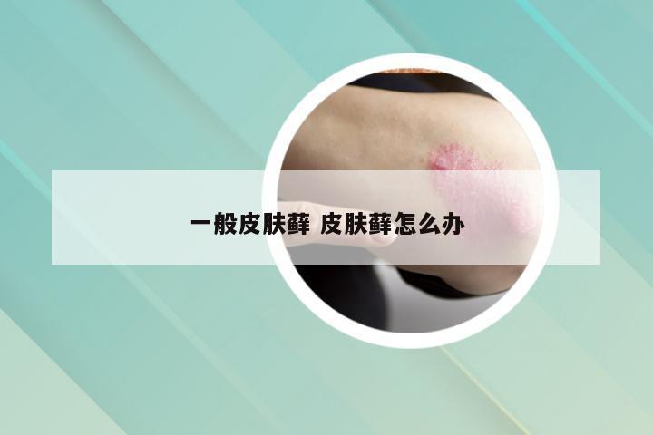 一般皮肤藓 皮肤藓怎么办