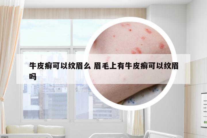牛皮癣可以纹眉么 眉毛上有牛皮癣可以纹眉吗