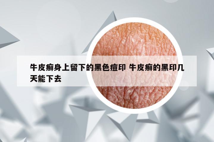 牛皮癣身上留下的黑色痘印 牛皮癣的黑印几天能下去