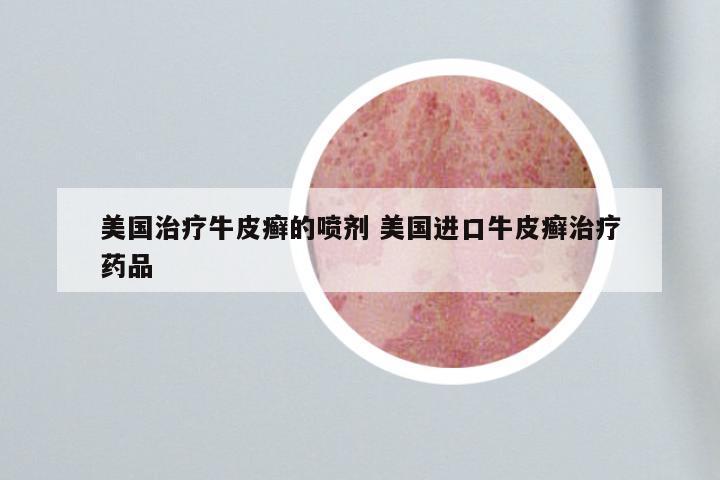 美国治疗牛皮癣的喷剂 美国进口牛皮癣治疗药品