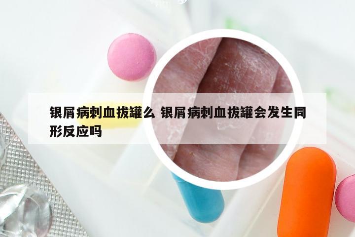 银屑病刺血拔罐么 银屑病刺血拔罐会发生同形反应吗