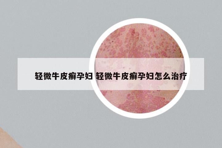 轻微牛皮癣孕妇 轻微牛皮癣孕妇怎么治疗