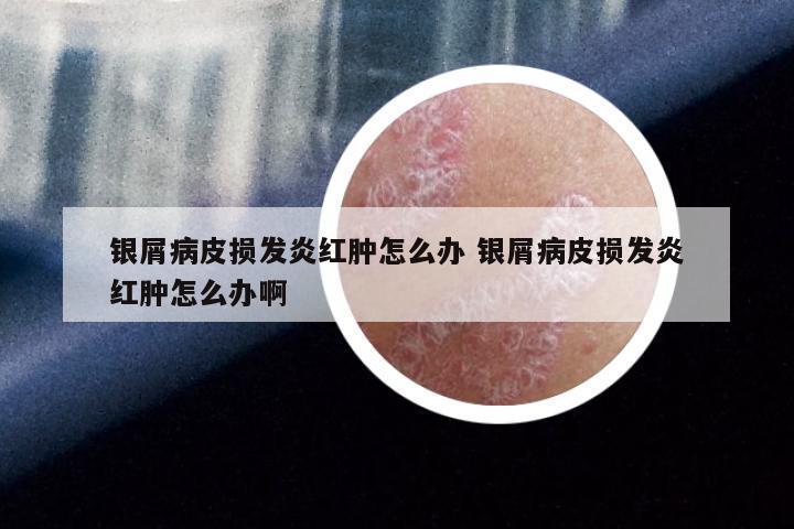 银屑病皮损发炎红肿怎么办 银屑病皮损发炎红肿怎么办啊