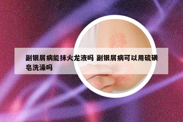 副银屑病能抹火龙液吗 副银屑病可以用硫磺皂洗澡吗