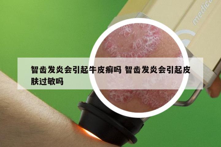 智齿发炎会引起牛皮癣吗 智齿发炎会引起皮肤过敏吗
