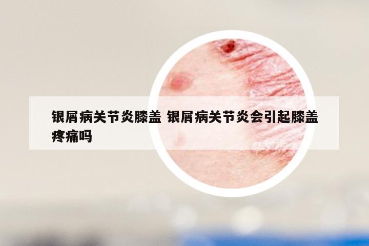 银屑病关节炎膝盖 银屑病关节炎会引起膝盖疼痛吗