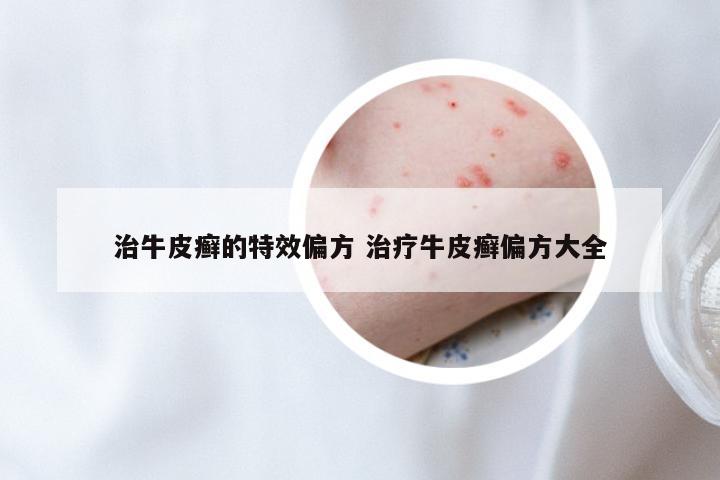 治牛皮癣的特效偏方 治疗牛皮癣偏方大全