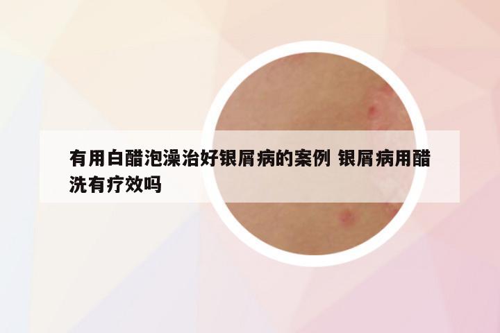 有用白醋泡澡治好银屑病的案例 银屑病用醋洗有疗效吗