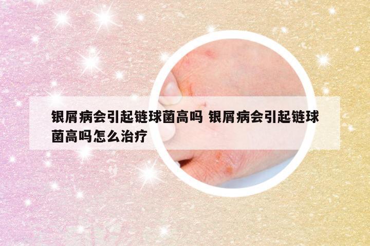 银屑病会引起链球菌高吗 银屑病会引起链球菌高吗怎么治疗