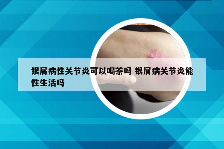 银屑病性关节炎可以喝茶吗 银屑病关节炎能性生活吗